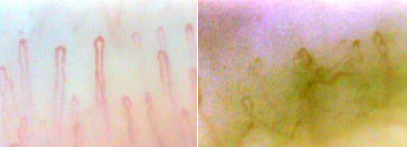 健康な人の毛細血管（左）と糖尿病網膜症患者の毛細血管（右）